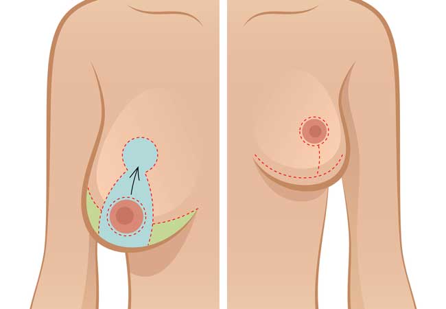 Brustchirurgie in Stuttgart