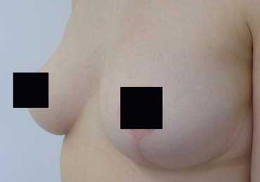 Brustvergrößerung mit Eigenfett Stuttgart
