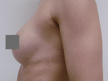 C brustvergrößerung Category:Breast implants