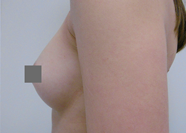 Brustvergrößerung Vorher Nachher Tropfenförmige Implantate, von A auf B
